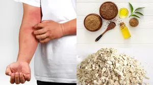 Natural Remedies for Eczema