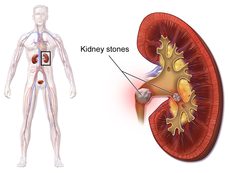 The function of the Kidneys is to maintain the water and electrolyte balance of the body. At times this excretion gets affected by changes in diet, hormone disorders. Home remedies for kidney stones.
